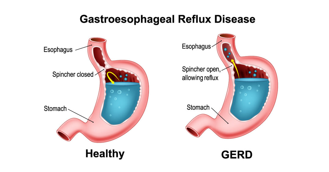 What Exactly is Acid Reflux?