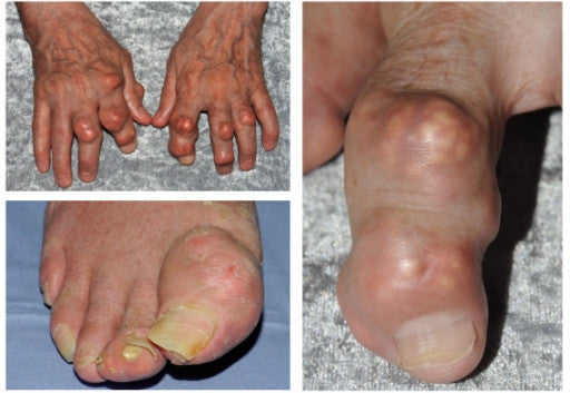 What is Gout and how do I treat it?